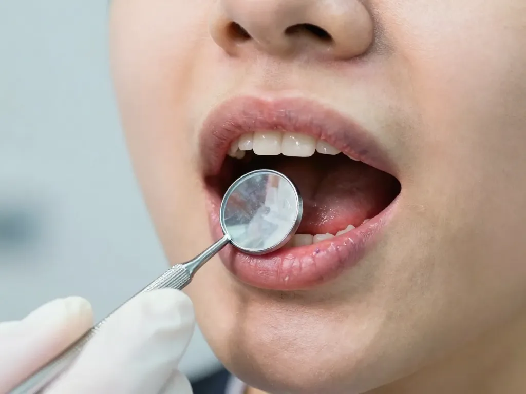 A close-up of a person's mouth showing purplish bruised gums, with a dentist gently examining the gums using a dental mirror. Good lighting, clinical background, realistic style.